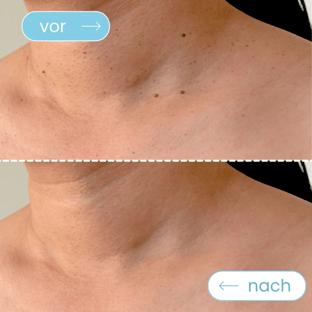 Mildara TagFrei™ Komplett-Set